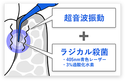 Blue Radicalのメカニズム