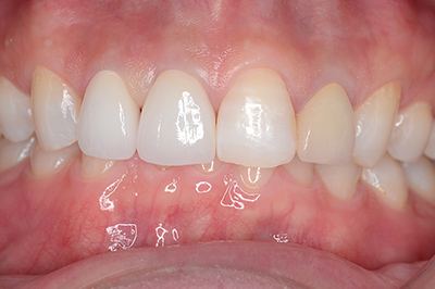 オールセラミック