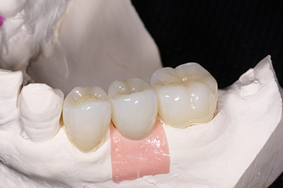 フルジルコニア