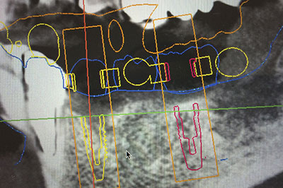 製作したサージカルガイドの最終チェック