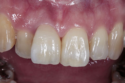 インプラントの被せ物装着