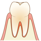 軽度の歯周病