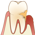中度の歯周病
