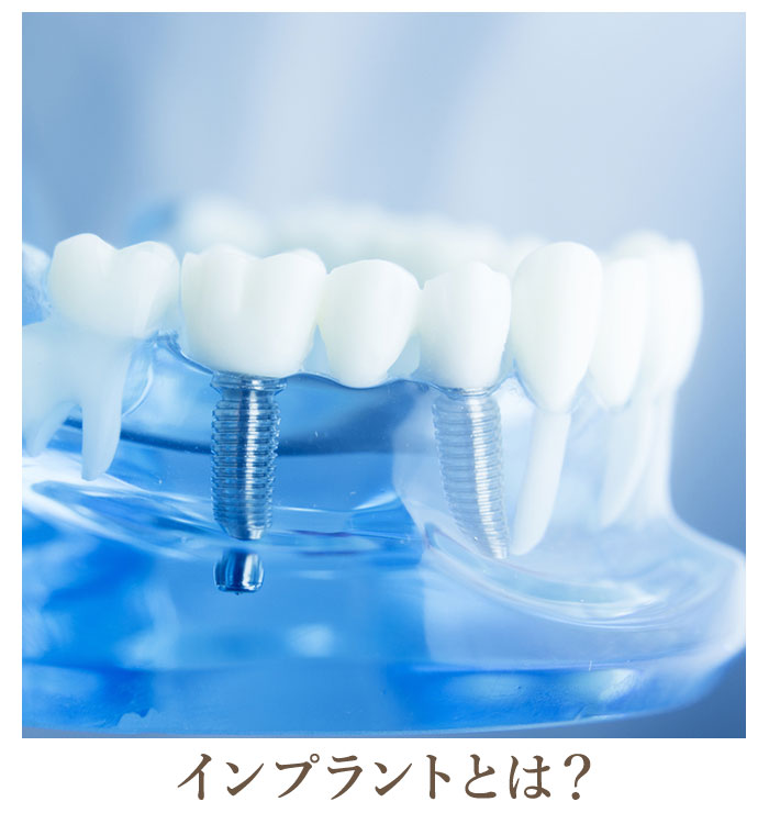 インプラントとは？