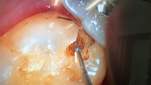 できるだけ削らない虫歯治療ができる