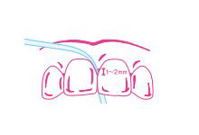 歯ぐきの中1～2mmまで入れます