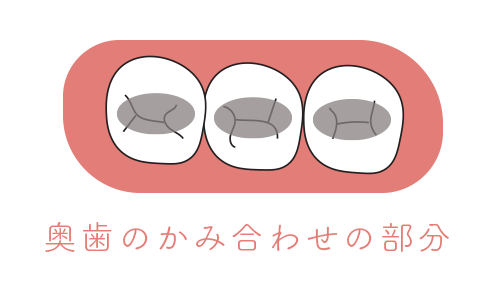 奥歯のかみ合わせの部分