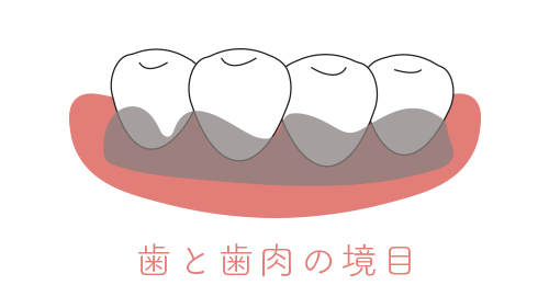 歯と歯肉の境目