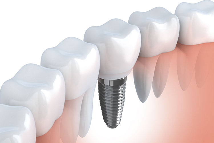 インプラントとは